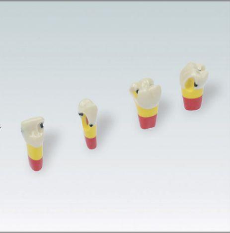 Modeltand AG-3 ZSDPKN OK 21 med caries